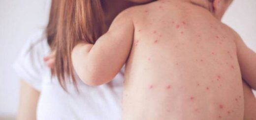 vacunación sarampión