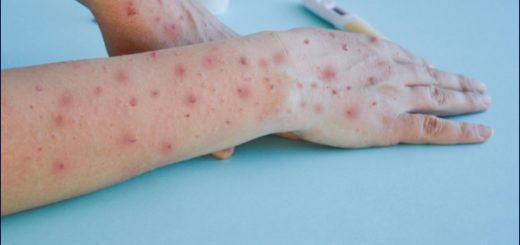 Viruela del mono podría convertirse en una pandemia